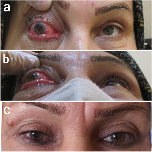 A case report and literature review of rare isolated metastatic papillary thyroid carcinoma in the orbit.
