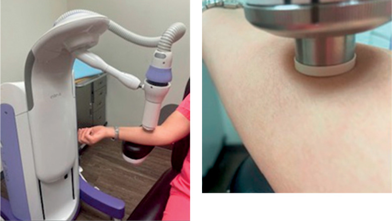 The Elekta Esteya<sup>®</sup> electronic brachytherapy system in non-melanoma skin cancers: A post-market observational study.