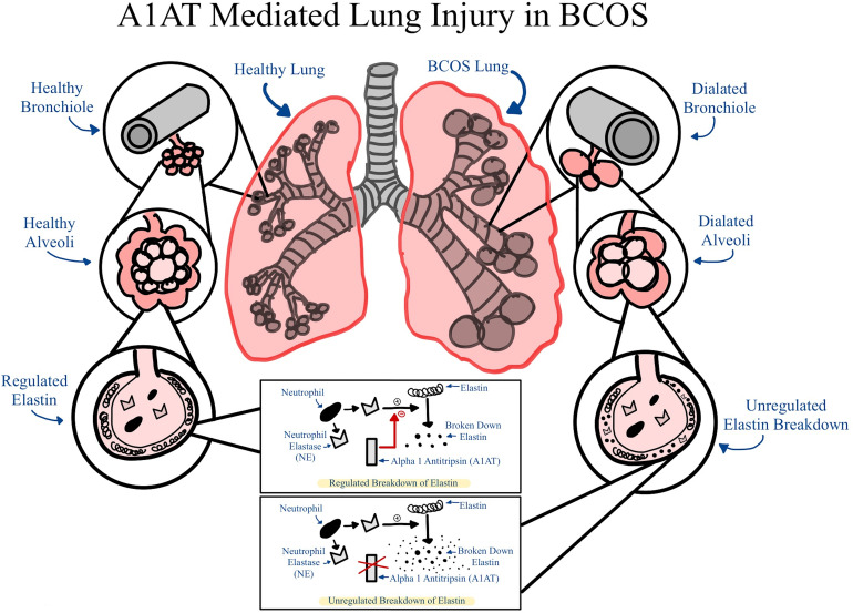 Bronchiectasis-COPD Overlap Syndrome: A Comprehensive Review of its Pathophysiology and Potential Cardiovascular Implications.