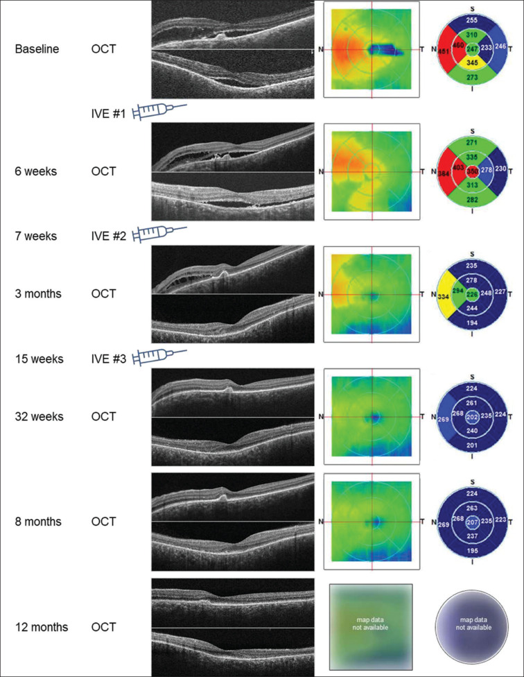 Intravitreal Aflibercept for Diffuse Choroidal Hemangioma in Sturge-Weber Syndrome.