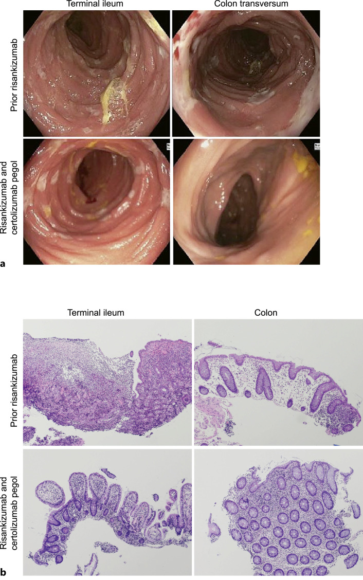 Risankizumab and Certolizumab Pegol Dual-Targeted Therapy for Crohn's Disease and Axial Spondyloarthritis: A Case Report.
