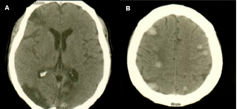 Brain metastases in a patient with antecedent of cardiac myxoma: a case report and review of literature