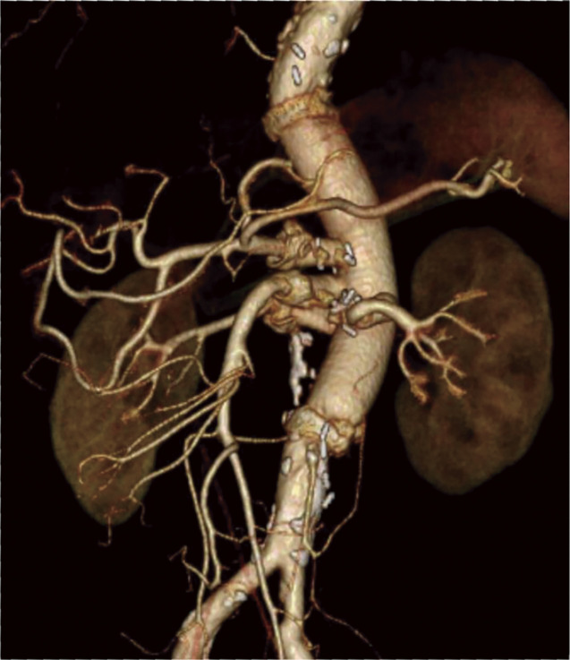 Infectious Thoracoabdominal Aortic Aneurysm Repair in a Patient with Myasthenia Gravis: A Case Report.