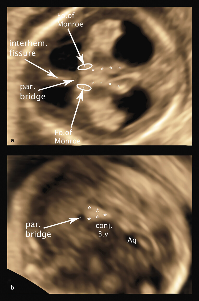 Detailed Analysis of Fetal Malformations of the Supratentorial Structures of the Brain in High-Risk Pregnancies at 12-14 Gestational Weeks by Transvaginal 3D Ultrasound Examination.