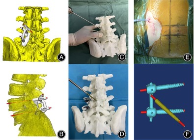 Innovative 3D Navigation Module for Precise Unilateral Pedicle Screw Combined with Contralateral Translaminar Facet Screw Placement in Lumbar Spine Surgery.