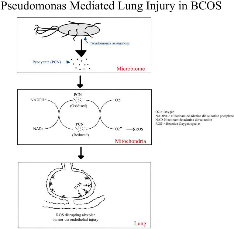 Bronchiectasis-COPD Overlap Syndrome: A Comprehensive Review of its Pathophysiology and Potential Cardiovascular Implications.