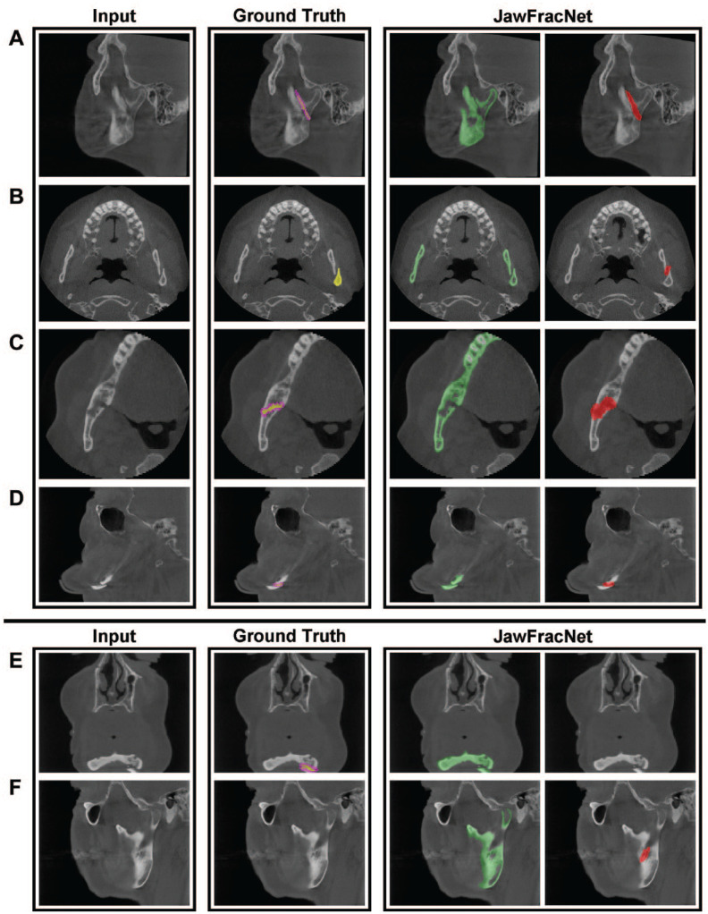 Detecting Mandible Fractures in CBCT Scans Using a 3-Stage Neural Network.