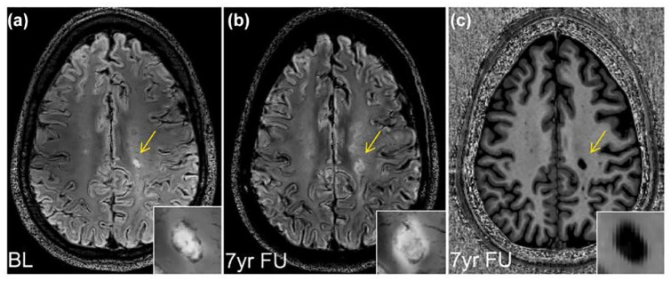 Chronic active lesions in multiple sclerosis: classification, terminology, and clinical significance.