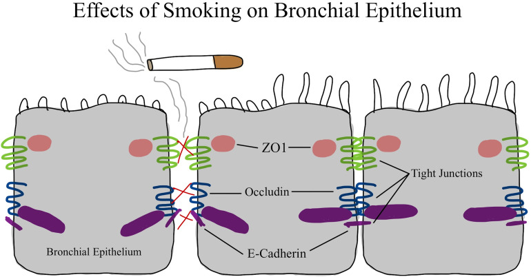 Bronchiectasis-COPD Overlap Syndrome: A Comprehensive Review of its Pathophysiology and Potential Cardiovascular Implications.