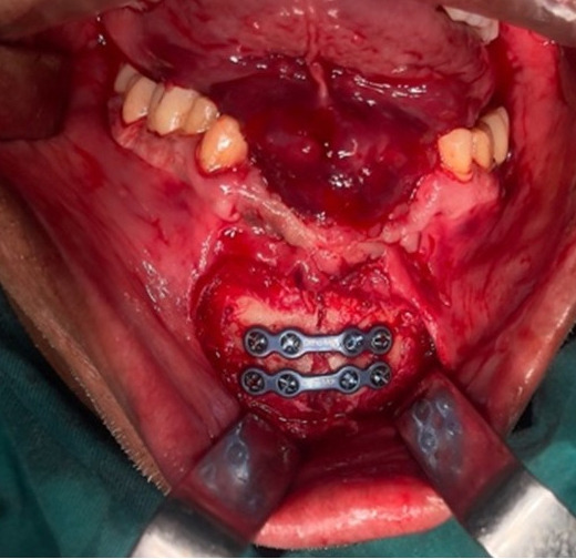 Sublingual hematoma as a complication of mandibular midline osteotomy: a case report and literature review.