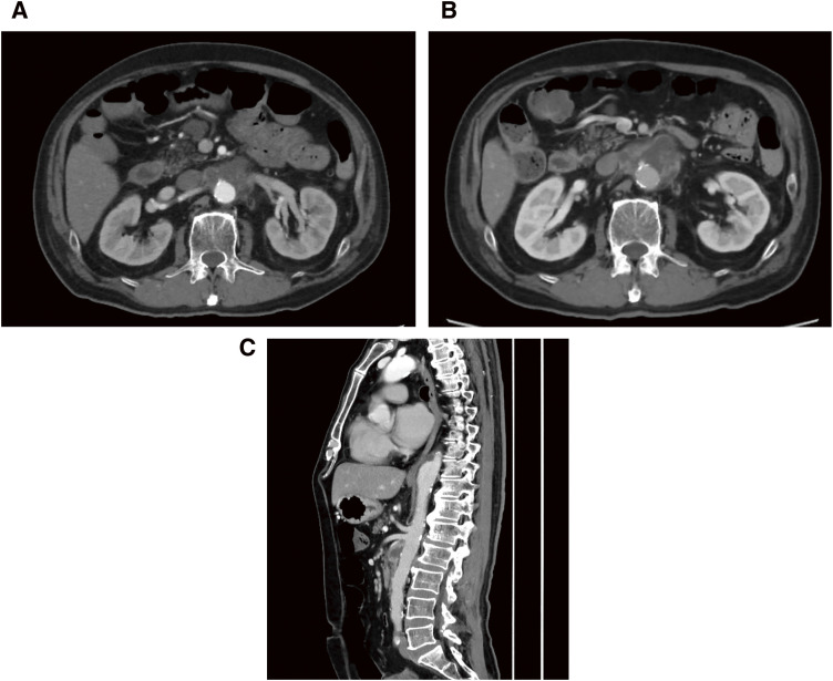 Infectious Thoracoabdominal Aortic Aneurysm Repair in a Patient with Myasthenia Gravis: A Case Report.