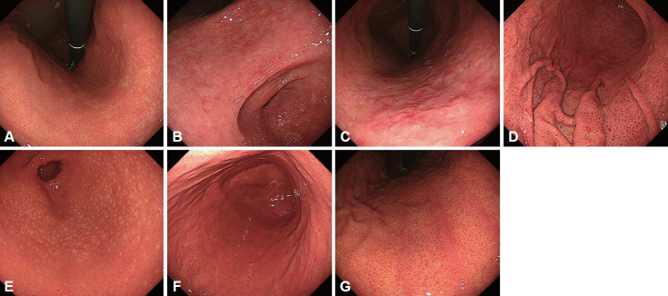 Endoscopic Diagnosis of Early Gastric Cancer and High-Risk Gastritis.