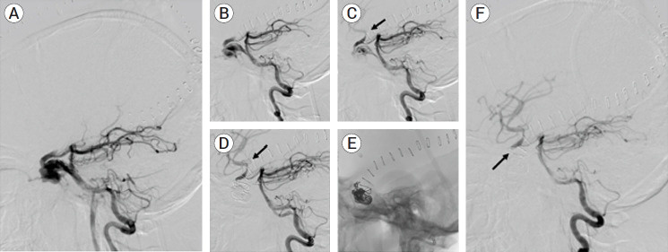 Deconstructive repair of a direct carotid-cavernous fistula via a posterior circulation retrograde approach.