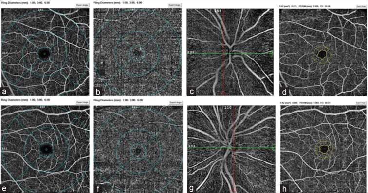 Evaluation of Macula and Optic Disc of Adult Amblyopia Patients with Diverse Etiologies using Optical Coherence Tomography Angiography.