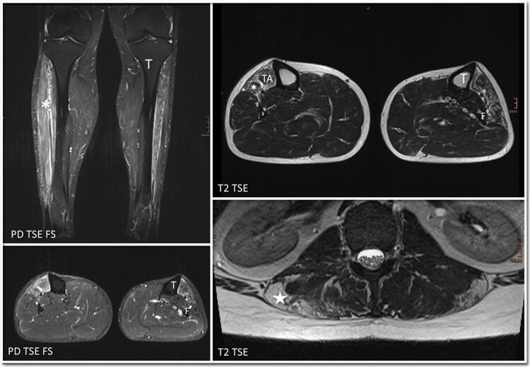 Bilateral foot drop as presenting feature of facioscapulohumeral muscular dystrophy type 1
