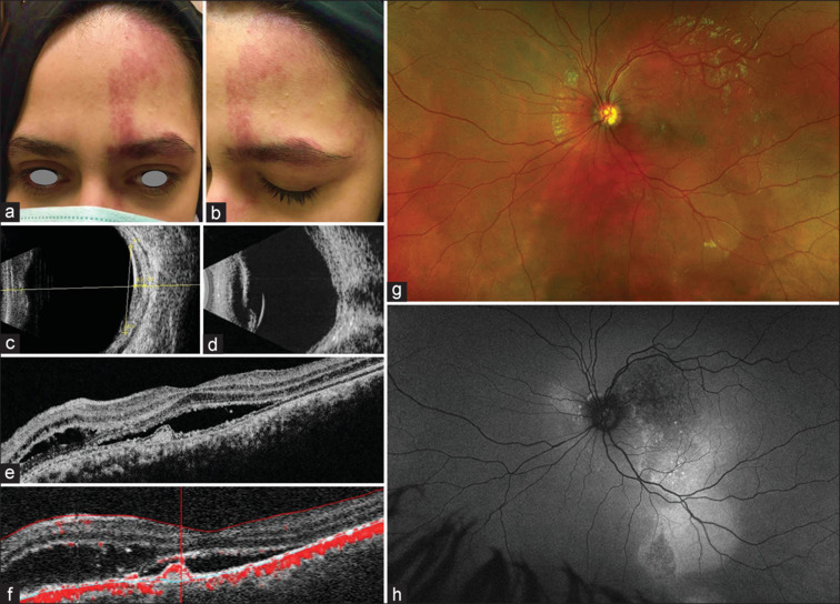Intravitreal Aflibercept for Diffuse Choroidal Hemangioma in Sturge-Weber Syndrome.