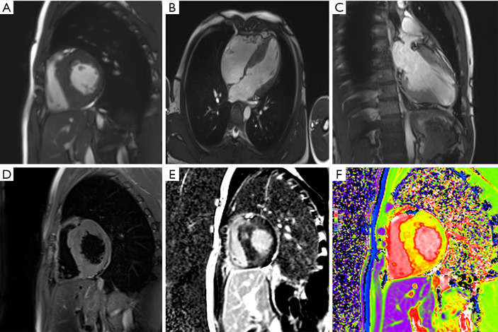 Challenges in clinical translation of cardiac magnetic resonance imaging radiomics in non-ischemic cardiomyopathy: a narrative review.