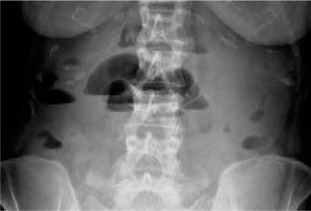 Small bowel obstruction secondary to uterine fibroids: a case presentation.
