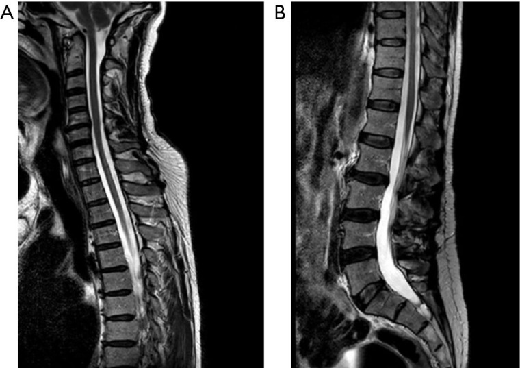 AQP4 antibody-seropositive neuromyelitis optica spectrum disorder in a patient with mixed connective tissue disease: a case report.