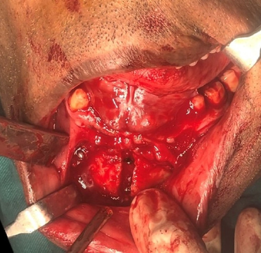 Sublingual hematoma as a complication of mandibular midline osteotomy: a case report and literature review.