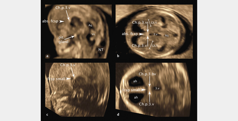 Detailed Analysis of Fetal Malformations of the Supratentorial Structures of the Brain in High-Risk Pregnancies at 12-14 Gestational Weeks by Transvaginal 3D Ultrasound Examination.