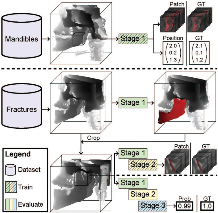 Detecting Mandible Fractures in CBCT Scans Using a 3-Stage Neural Network.