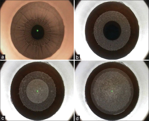 Femtosecond-laser-assisted Small Incision Lenticule Extraction to Treat Refractive Error: A Narrative Review.