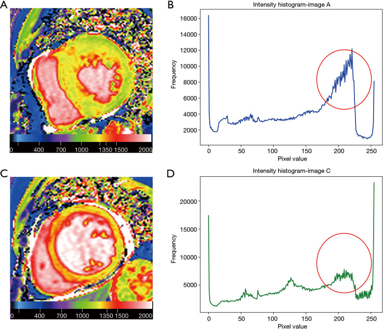 Challenges in clinical translation of cardiac magnetic resonance imaging radiomics in non-ischemic cardiomyopathy: a narrative review.