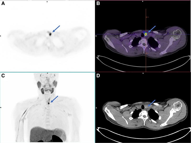 Successful Localization of Recurrent MEN-1-Associated Hyperparathyroidism With 18F-Fluorocholine PET/CT.