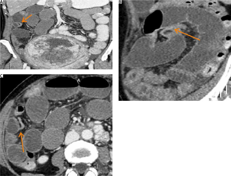 Small bowel obstruction secondary to uterine fibroids: a case presentation.