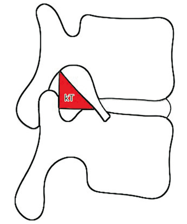 Anatomical assessment of the Kambin's triangle for percutaneous posterolateral transforaminal endoscopic surgery of lumbar intervertebral discs: a magnetic resonance imaging based study.