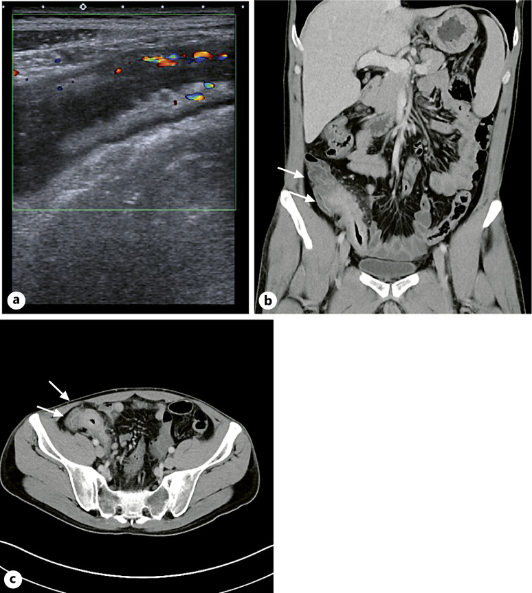 Risankizumab and Certolizumab Pegol Dual-Targeted Therapy for Crohn's Disease and Axial Spondyloarthritis: A Case Report.