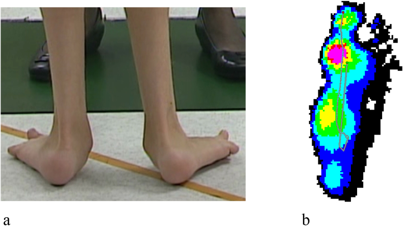 Clinical Measures Associated With Tibial Torsion in Ambulatory Children With Cerebral Palsy and Pes Valgus.