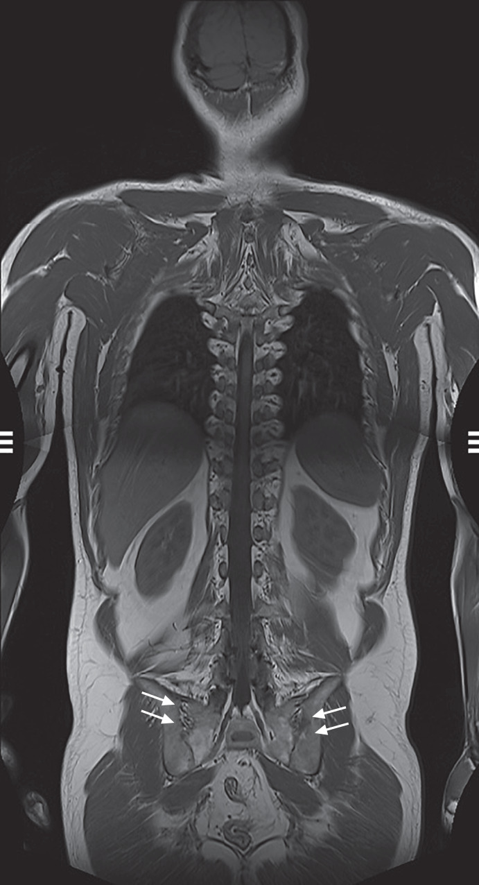 Risankizumab and Certolizumab Pegol Dual-Targeted Therapy for Crohn's Disease and Axial Spondyloarthritis: A Case Report.