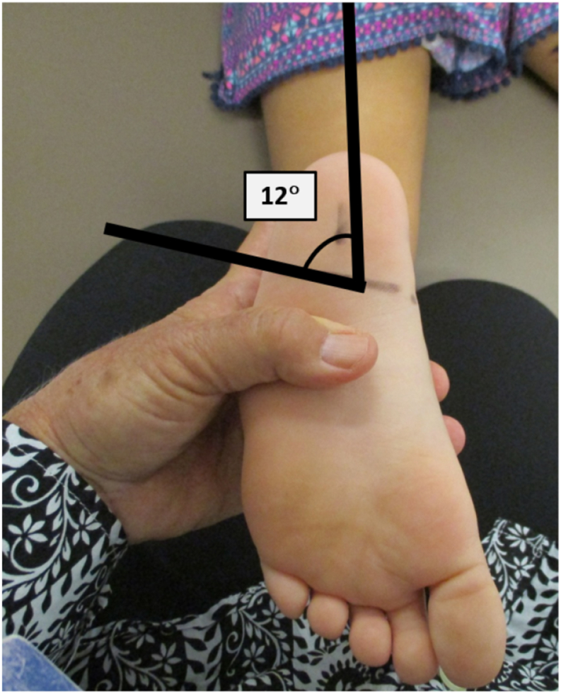 Clinical Measures Associated With Tibial Torsion in Ambulatory Children With Cerebral Palsy and Pes Valgus.