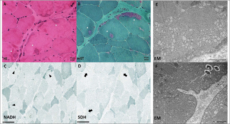 Congenital tubular aggregates myopathy associated with central nervous system involvement: description of a case.