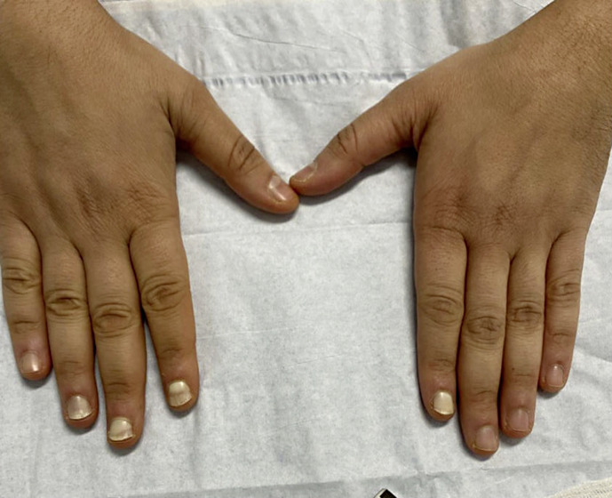 Treatment of Hereditary Leukonychia with Intramatricial Triamcinolone: A Case Report.