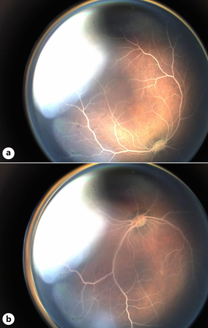 Serendipitous Discovery of Lipemia Retinalis in a Premature Infant: A Case Report.