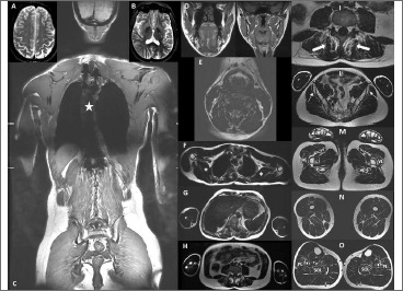 Congenital tubular aggregates myopathy associated with central nervous system involvement: description of a case.