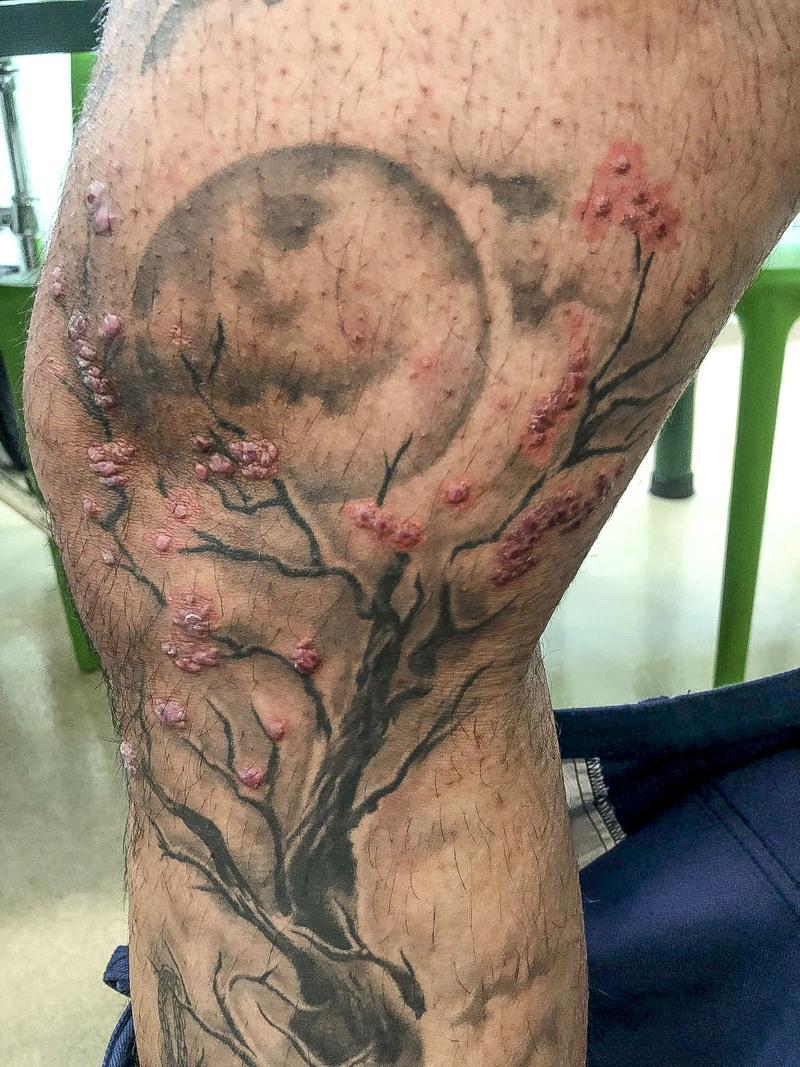 Tattoo-induced immunologic reaction to red inks.