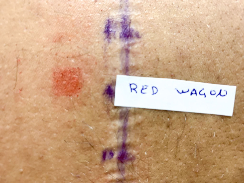 Tattoo-induced immunologic reaction to red inks.