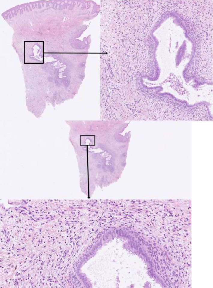 Dermoscopic Features of Cutaneous Endometriosis Arising in a Cesarean Scar: A Case Report.