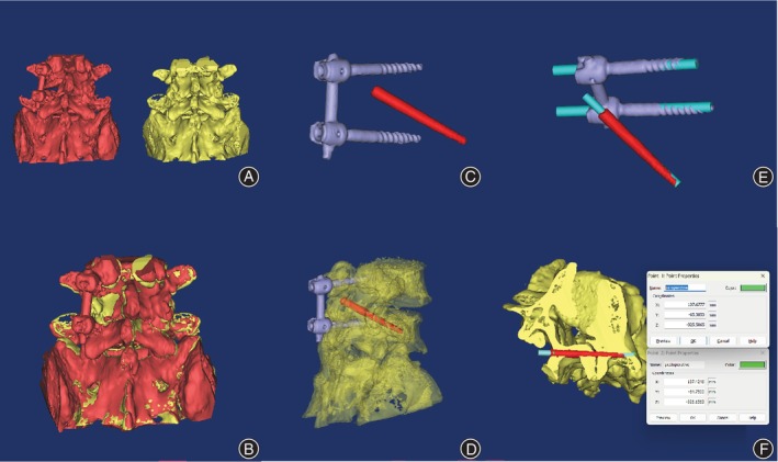 Innovative 3D Navigation Module for Precise Unilateral Pedicle Screw Combined with Contralateral Translaminar Facet Screw Placement in Lumbar Spine Surgery.