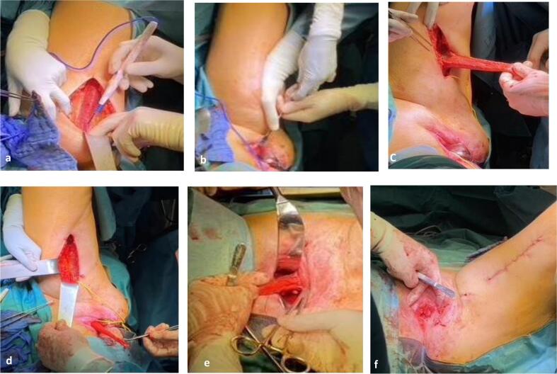 Gracilis flap and partial colpocleisis of Kahr for pelvic organ prolapse after anterior exenteration: A case report