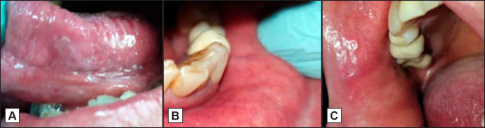 Aphthous-Like Stomatitis in a Patient Receiving Panitumumab.