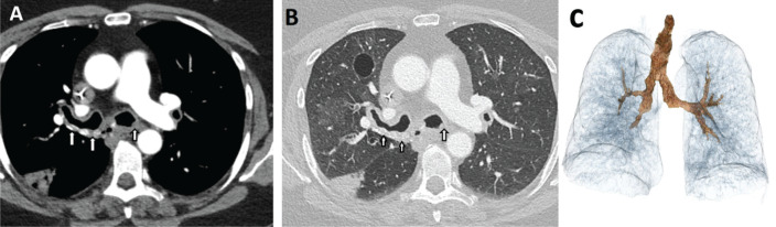 A Rare Cause of Dyspnea in a Patient with Multiple Myeloma: Tracheobronchial Amyloidosis