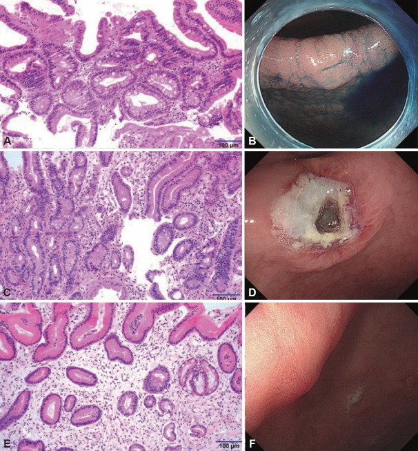 Pathological Evaluation of the Therapeutic Effects of Argon Plasma Coagulation in Gastric Low-Grade Dysplasia.