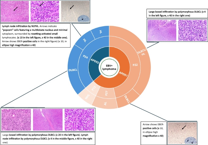 Report of the Italian Cohort with Activated Phosphoinositide 3-Kinase δ Syndrome in the Target Therapy Era.