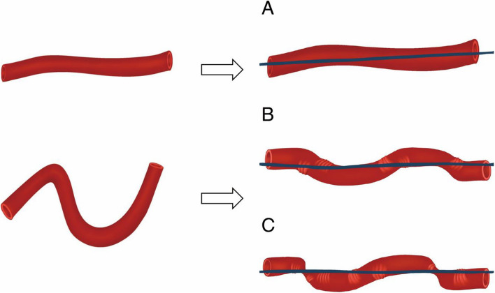 Hepatic artery stenting with Viabahn.