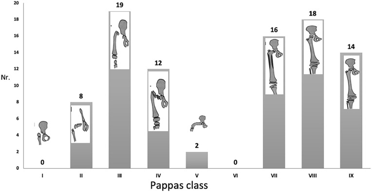 Ankle and foot deformities and malformations in proximal femoral focal deficiency.